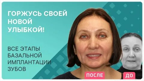 Импланты отзывы пациентов реальные