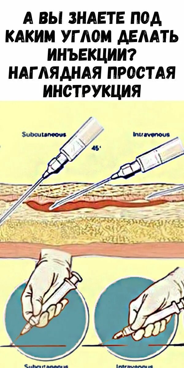 Углы введения инъекций. Под каким углом делать укол. Внутривенно внутримышечно подкожно. Уколы под углом.