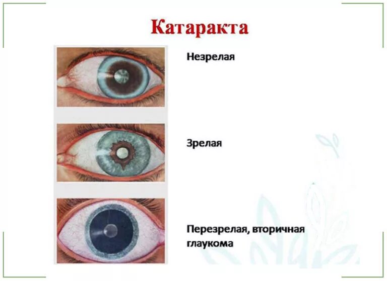 Факосклероз глаз что это такое