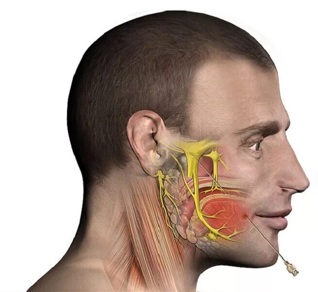 Neuralgia тройничный нерв. Ризотомия тройничного нерва. Радиочастотная ризотомия тройничного нерва. Тройничный нерв восполен. Невропатия затылочного