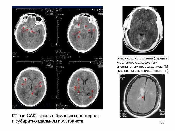 Цистерны мозга расширены. Субарахноидальное кровоизлияние мрт. Базальные цистерны головного мозга кт. Субарахноидальное кровоизлияние головного мозга на кт. Субарахноидальное кровоизлияние кт протокол.