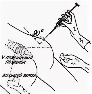 Укол техника выполнения. Внутримышечная инъекция в ягодицу алгоритм. Укол ВМ В ягодицу алгоритм. Алгоритм инъекции внутримышечной инъекции. Техника выполнения внутримышечной инъекции в ягодицу.