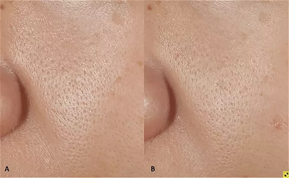 Расширенные поры признак. Расширенные поры жирное на лице. Расширенные поры на груди. Кожа с расширенными порами. Расширенные поры признак.