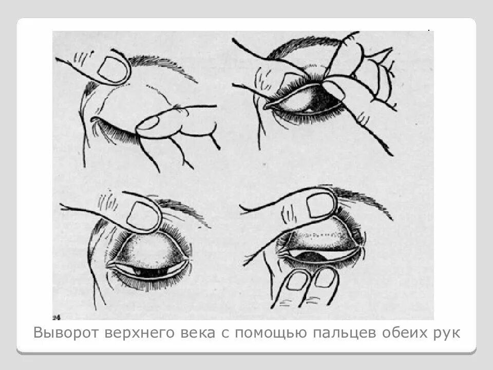 Методика выворачивания верхнего века глаза. Выворот верхнего века алгоритм. Выворот верхнего века алгоритм. Как вывернуть верхнее веко. Осмотр конъюнктивы нижнего и верхнего века, выворот век.