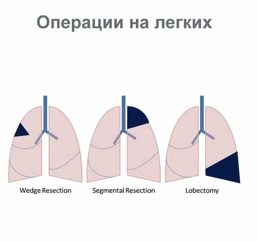 После лобэктомии легкого. После операции на легком.