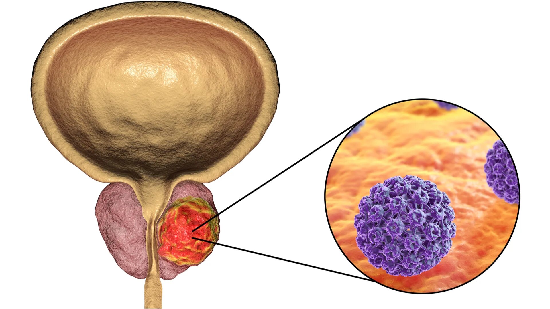 Видеоурок простата. Cancer предстательной железы. Раковые клетки простаты. Злокачественное новообразование простаты.
