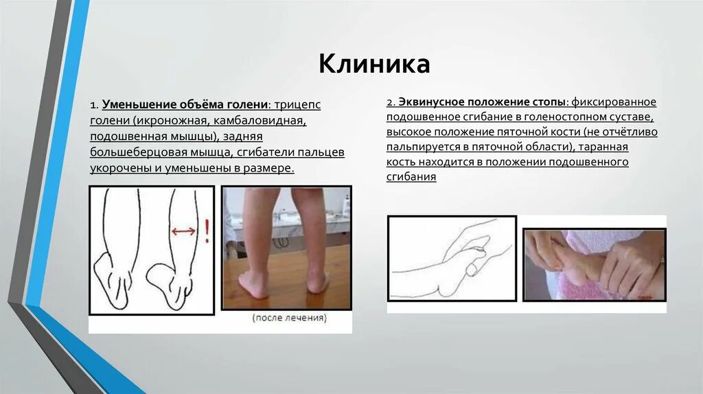 Голеностопный сустав клиника. Эквиноварусная косолапость стопы. Эквинусное положение стопы. Врожденная косолапость стопы. Эквинусная деформация стопы рентген.