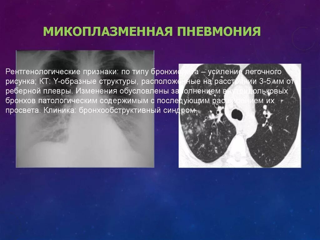 Пневмония при ковиде симптомы. Микоплазматическая пневмония. микоплазменной пневмонии. пневмония на кт.