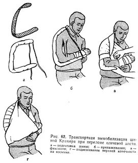 Иммобилизация плечевой кости