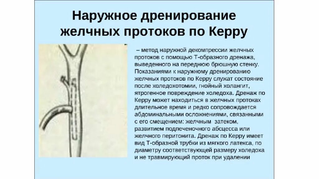 Дренаж холедоха по керу. Дренирование желчных протоков по керу. Наружное дренирование желчных протоков. Внешнее дренирование желчных протоков;. Трубка в желчном пузыре