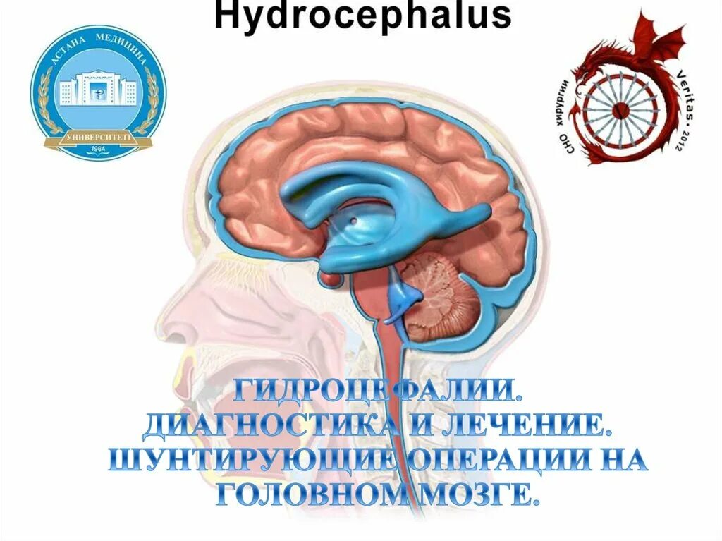 Как выглядит шунт. Операции при гидроцефалии.