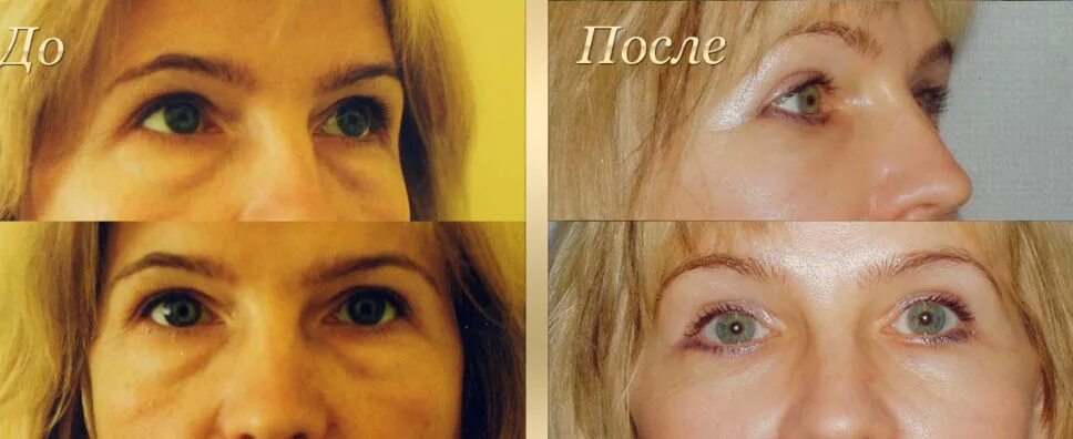 китаянки после блефаропластики. выступец борис владимирович блефаропластика. блефаропластика сагынбаева. блефаропластика в южно сахалинске. реабилитация после блефаропластики нижних век.