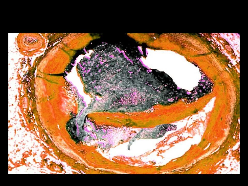 Тромбоз атеросклеротической бляшки. Атеросклеротическая бляшка с обтурирующим тромбом. Тромб и атеросклеротическая бляшка разница. Атеросклеротическая бляшка с обтурирующим тромбом микропрепарат. Тромб и бляшка разница