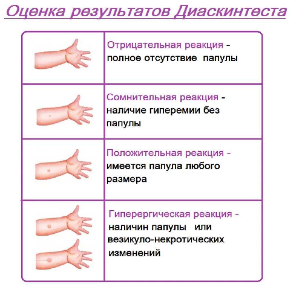 Каким должен быть диаскинтест у детей