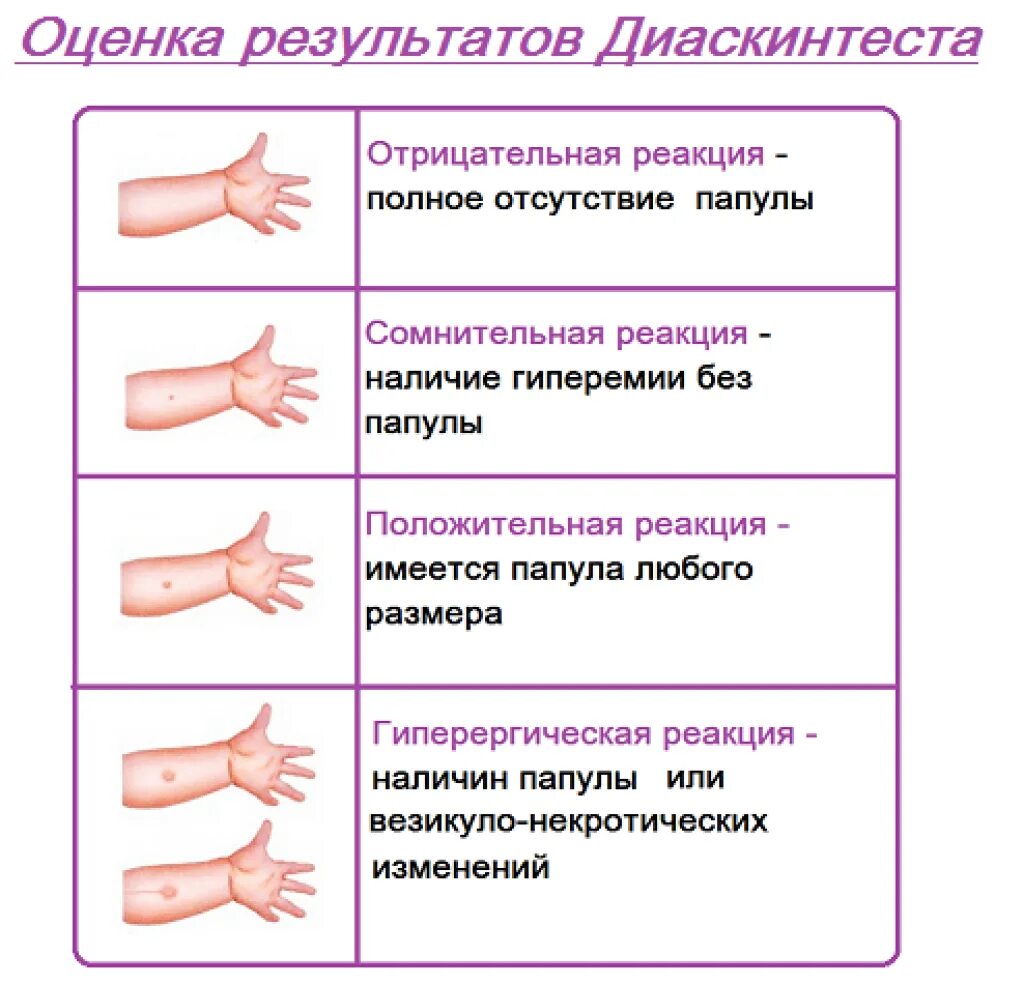 Как должна манта у ребенка. Диаскинтест оценка результатов через. Оценка результатов диаскинтест норма. Диаскинтест показатели у детей. Норма прививки диаскинтест.