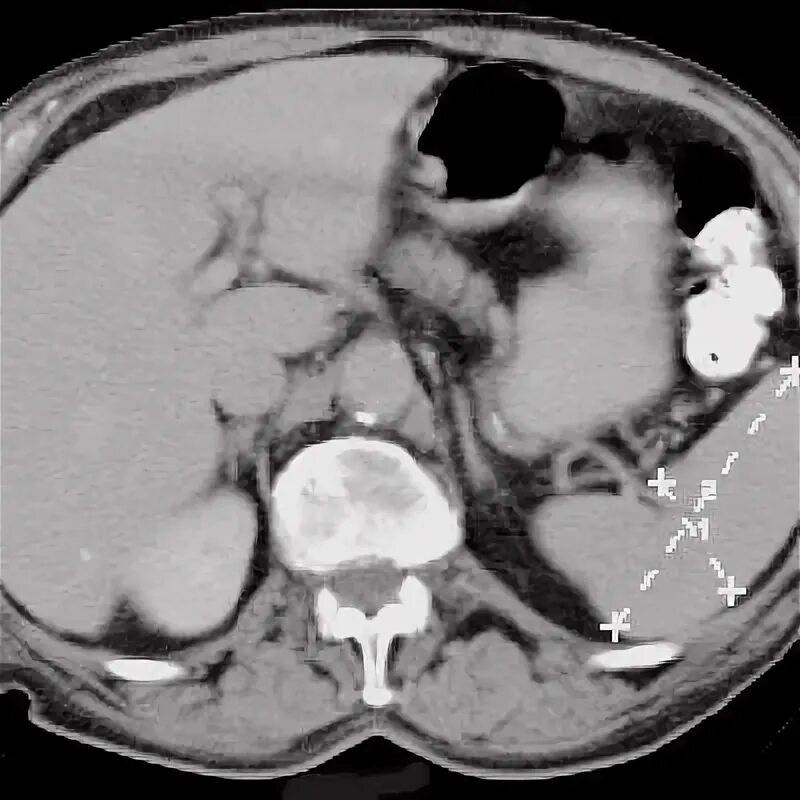 Селезенка на кт норма. Кальцинаты в селезенке на кт. Измерение размеров селезенки на кт. Индекс селезенки