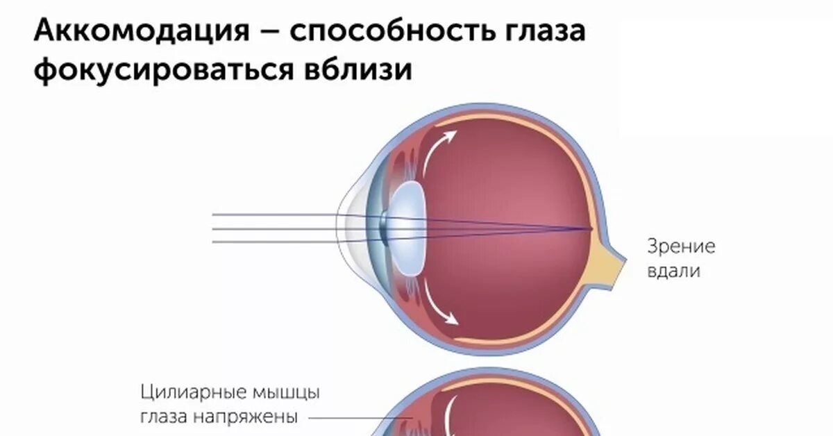 В аккомодации участвуют. Мышцы аккомодации глаза. Спазм аккомодации хрусталика. Нарушение аккомодации. Нарушение аккомодации глаза.