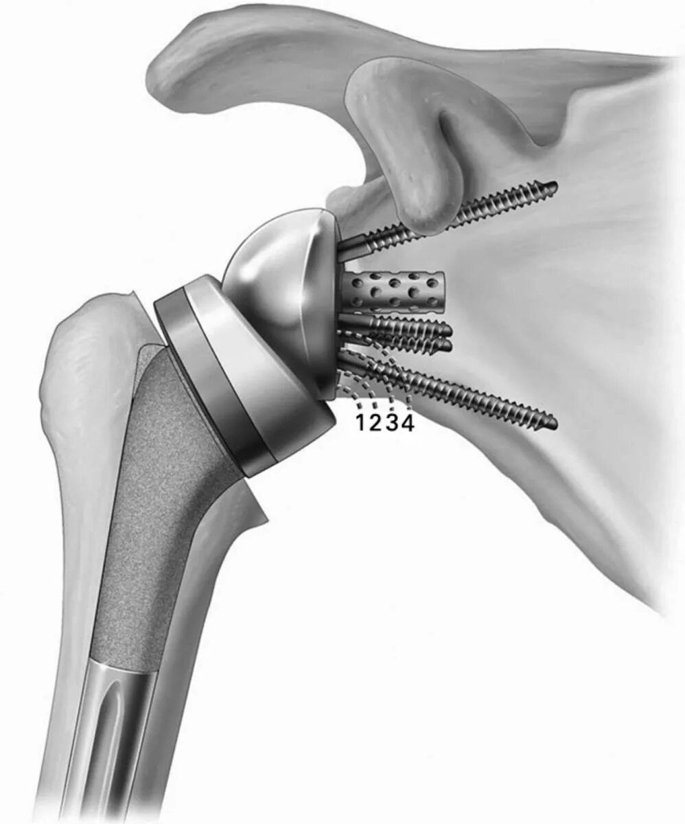 Эндопротез плечевого сустава рентген. Delta Xtend эндопротез плечевого сустава. Эндопротез плечевго сустава Рент. Эндопротез плечевого сустава Тотальный реверсивный. Операция по замене плечевого сустава