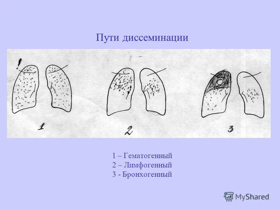 Лимфогенный туберкулез. Лимфогенный диссеминированный туберкулез. Диссеминированный туберкулез схема. Диссеминированный туберкулез легких схема. Диссеминированный туберкулез схематично.