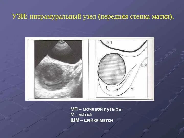 Интрамуральный миоматозный узел. Передняя стенка матки. Интрамуральный узел в матке что это. Интрамуральный миоматозный узел матки что это. Миома на задней стенке матки