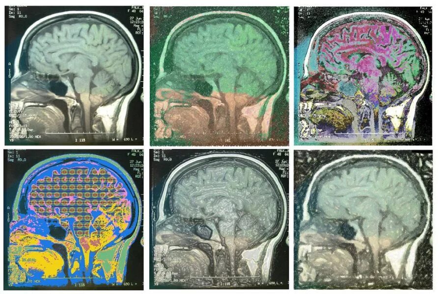 Мрт с контрастом головного. Магнитно-резонансная томография головного мозга с контрастированием. Мрт контрастирование. Мрт головного мозга с контрастом. Мрт головы с контрастом.