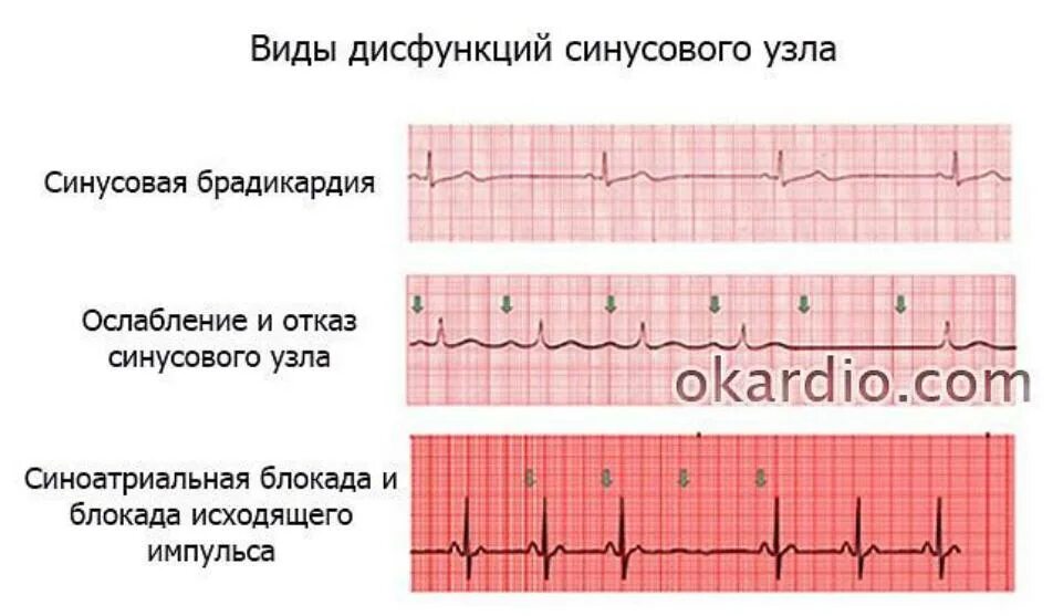 Дисфункция синусового узла что это. ЭКГ при синдроме слабости синусового узла. Синдром слабости синусового узла ЭКГ признаки. Слабость синусового узла симптомы на ЭКГ. ЭКГ критерии дисфункции синусового узла.