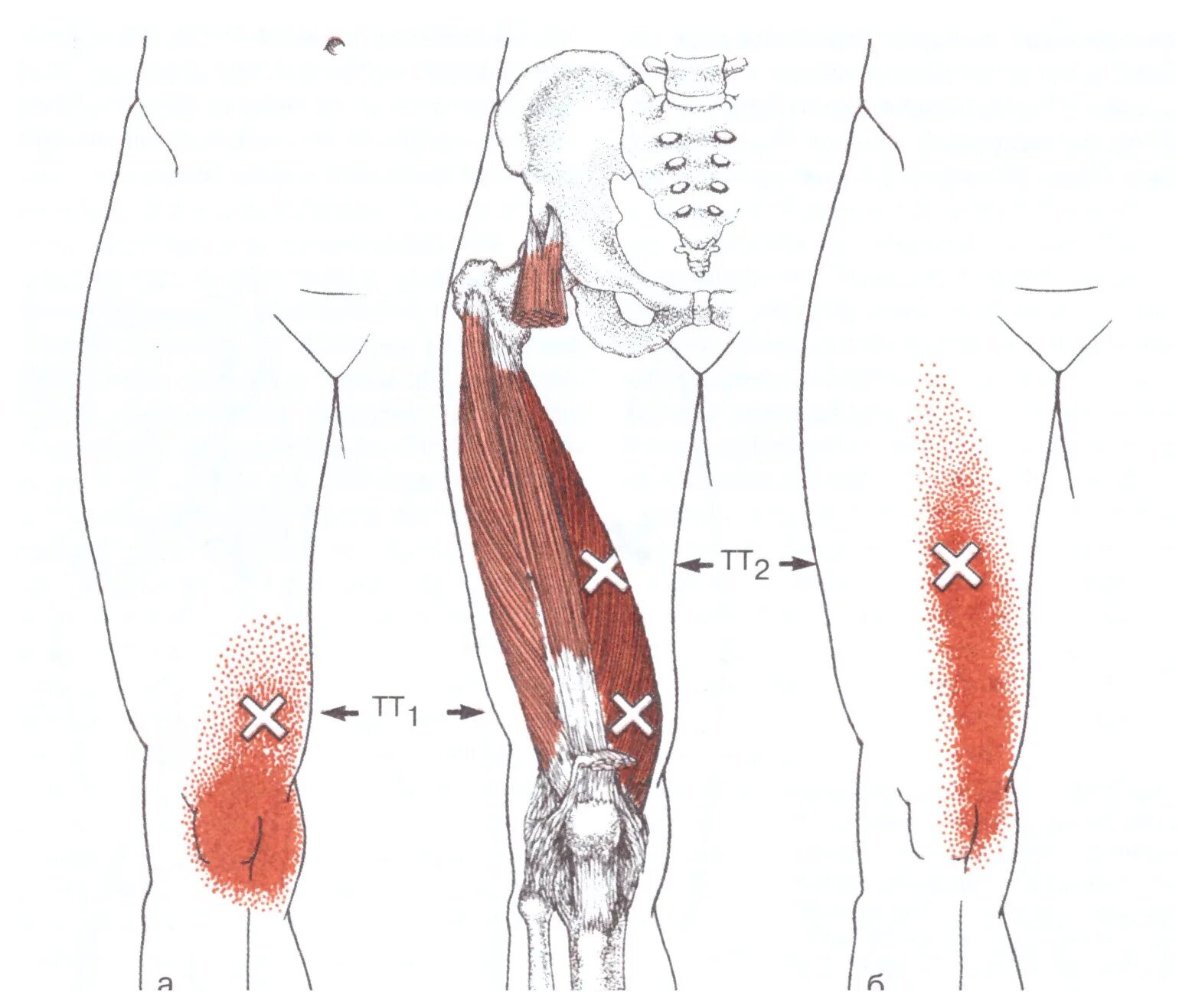 Отдает в пах у мужчин причины. Триггерные точки при трохантерите. Триггерные точки мышц бедра. Триггерные точки колена. Болит колено триггерные точки.