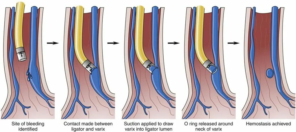 эндоскопическое лигирование варикозно расширенных вен пищевода. эндоскопическая склеротерапия варикозно расширенных вен пищевода. легирование вен пищевода что это. легирование пищевода. легирование пищевода.