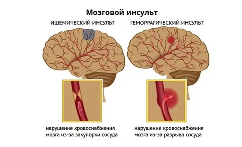 Кровоизлияние ствола мозга. Ишемический и геморрагический инсульт головного мозга. Закупорка сосудов головного мозга инсульт. Геморрагический инсульт головного мозга симптомы. Типы ишемического инсульта.