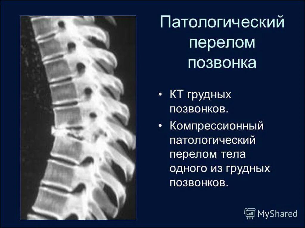 Компрессионный перелом позвоночника th5. Компрессионный перелом позвоночника th-5-6. Компрессионный перелом l1 th12. Компрессионный перелом грудного позвонка рентген. Компрессионный перелом тела 1 1