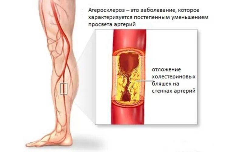 Облитерирующий атеросклероз сосудов нижних конечностей. Облитерирующий атеросклероз сосудов ног. Облитерирующий атеросклероз периферических артерий. Облитерирующий атеросклероз артерий ног.