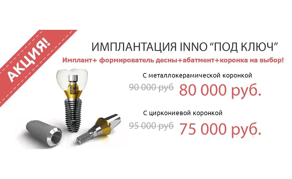 Срок службы импланта зуба. Имплант зуба схема установки. Имплант системы xive. Импланты nobel biocare. Балочный протез на имплантах.