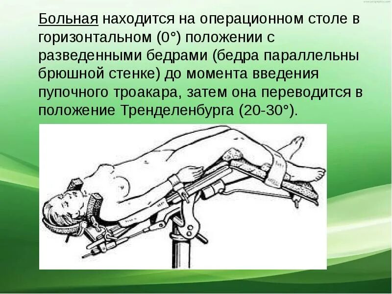 Положение тренделенбурга что это такое фото Тренделенбурга положение