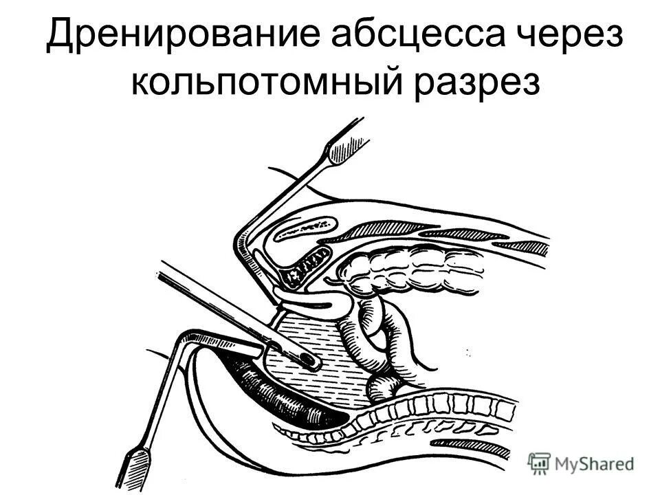дренирование абсцесса по мональди. дренаж при абсцессе. дренирование двенадцатиперстной кишки. мональди дренирование. дренаж при абсцессе.