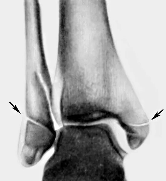 Голеностопный сустав клиника. Перелом медиальной лодыжки большеберцовой кости. Перелом Дюпюитрена рентген лодыжка. Перелом Дюпюитрена лодыжки. Остеосинтез перелома Дюпюитрена.