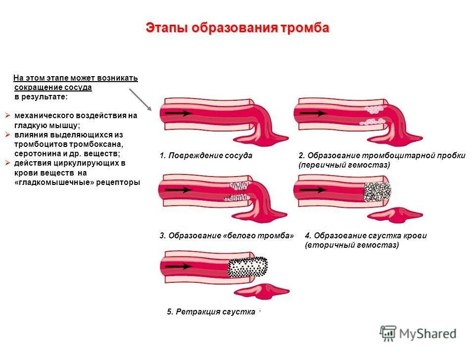 Стадии образования сгустка крови. Этапы формирования тромба. Этапы образования тромба. Стадии тромбообразования (фазы):. Механизм тромбоза