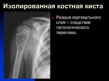 Костно фиброзные