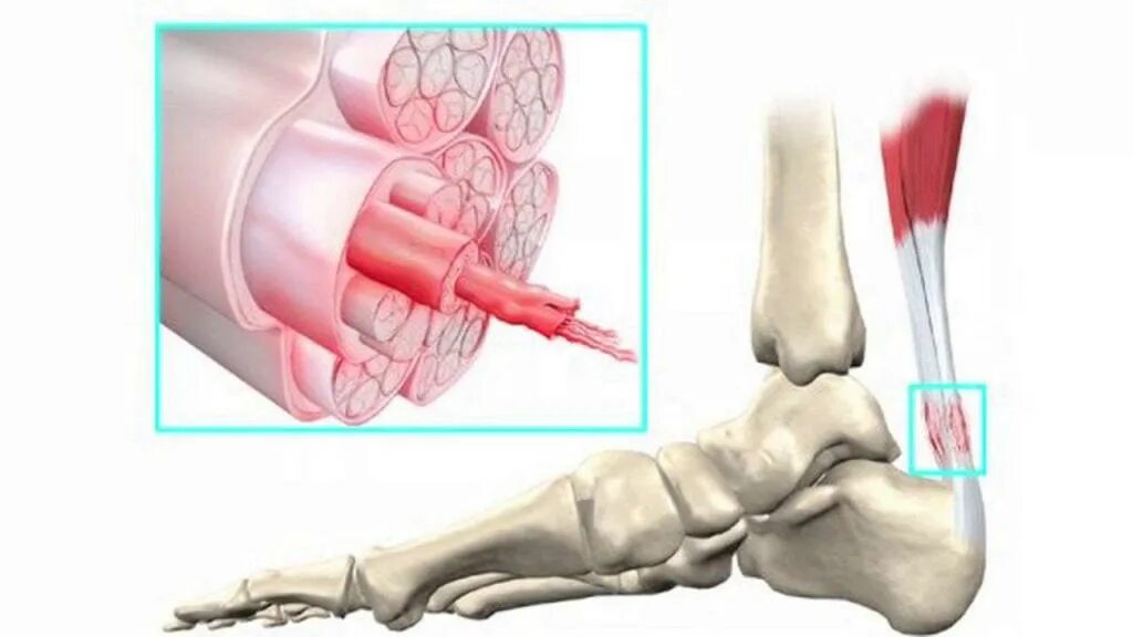 Тендинит ахиллова сухожилия. Тендовагинит ахиллова. Теедит ахиллова сухожилия. Тендопатия ахиллесова сухожилия.