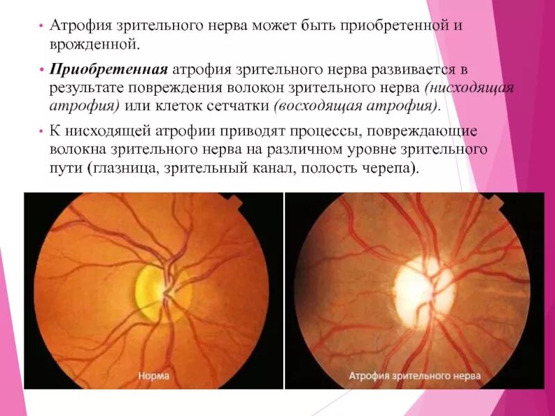 Нисходящий нерв. Неврит зрительного нерва симптоматика. Патогенез атрофии зрительного нерва. Причины развития атрофии зрительного нерва.