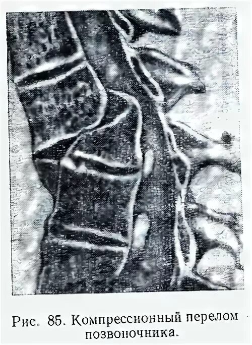Переломы позвонков классификация. Перелом позвонка инвалидность. Когда дают инвалидность при переломе позвоночника. Реабилитация после травмы позвоночника. Перелом позвонка инвалидность.