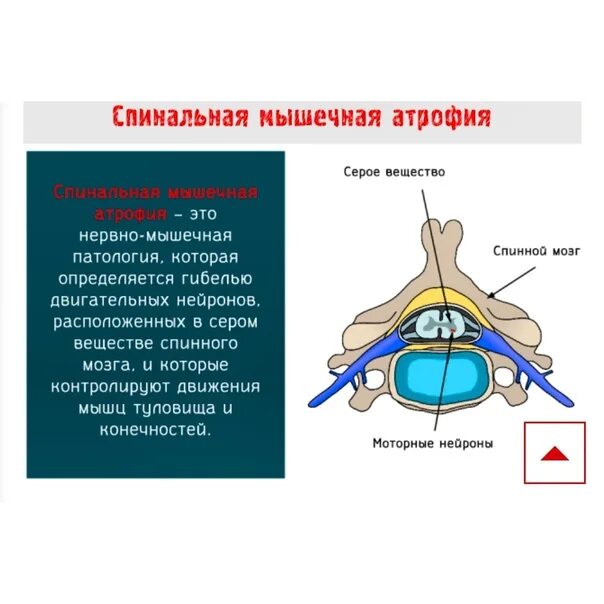 Спинная атрофия. Спинальная мышечная атрофия. Спинальная мышечная атрофия патогенез. Спинальная мышечная атрофия 2 типа. Спинальная мышечная атрофия генетика.