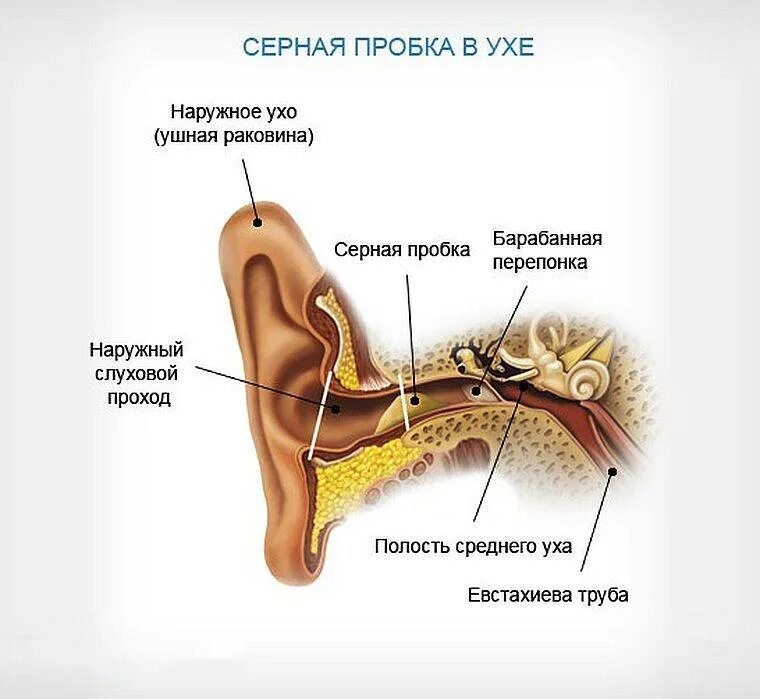 Как определить пробку в ухе