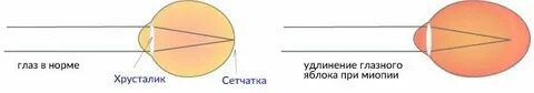 Удлинить глазное яблоко