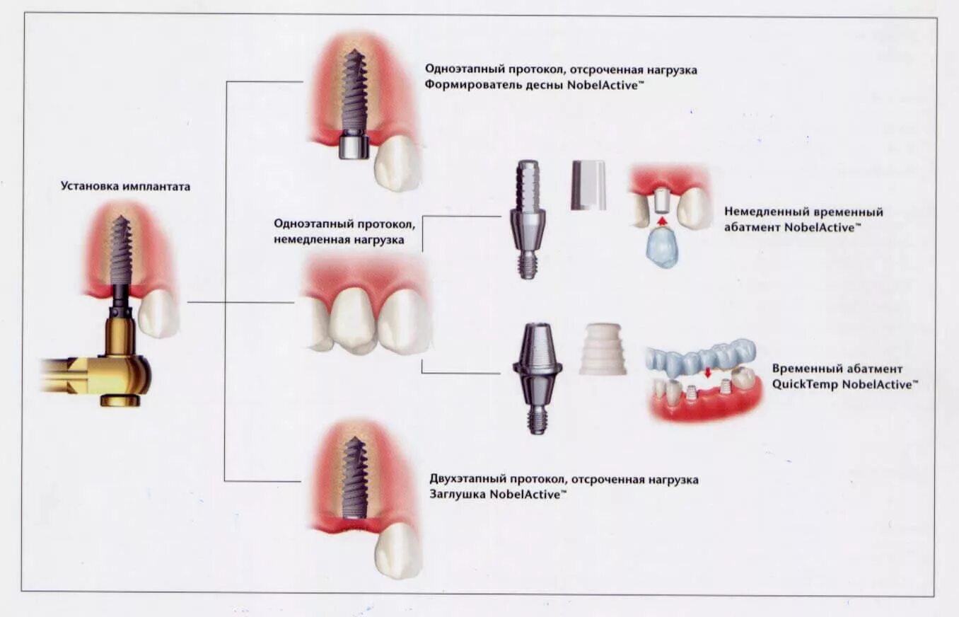 Через сколько можно вставлять зубы. Этапы одномоментной имплантации зуба. Схема установки импланта зуба. Импланты схема установки имплантация зубов. Этапы имплантации зубов абатмент.