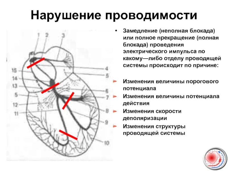 Нарушение внутрижелудочного проведения. Нарушение функции проводимости экг. проводящая система сердца блокады экг. нарушения проводящей системы сердца на экг. нарушение проведения импульса по проводящей системе сердца это.