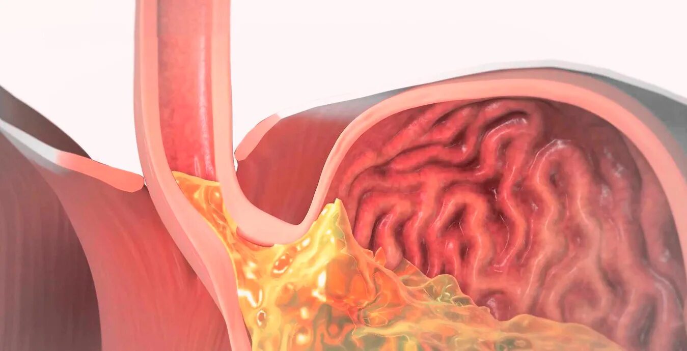 Пролапс желудка в пищевод. Гастроэзофагеальная рефлюкс эзофагит. Гастро эзофагит рефлюкс. Рефлюкс эзофагит патанатомия.