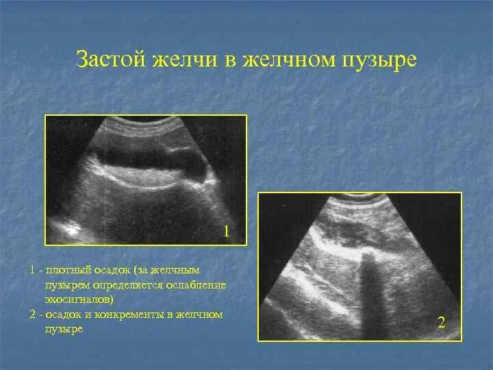 Застой желчного пузыря у взрослого симптомы. Сонограмма желчного пузыря. Сладж феномен желчного пузыря. Застойный желчный пузырь.