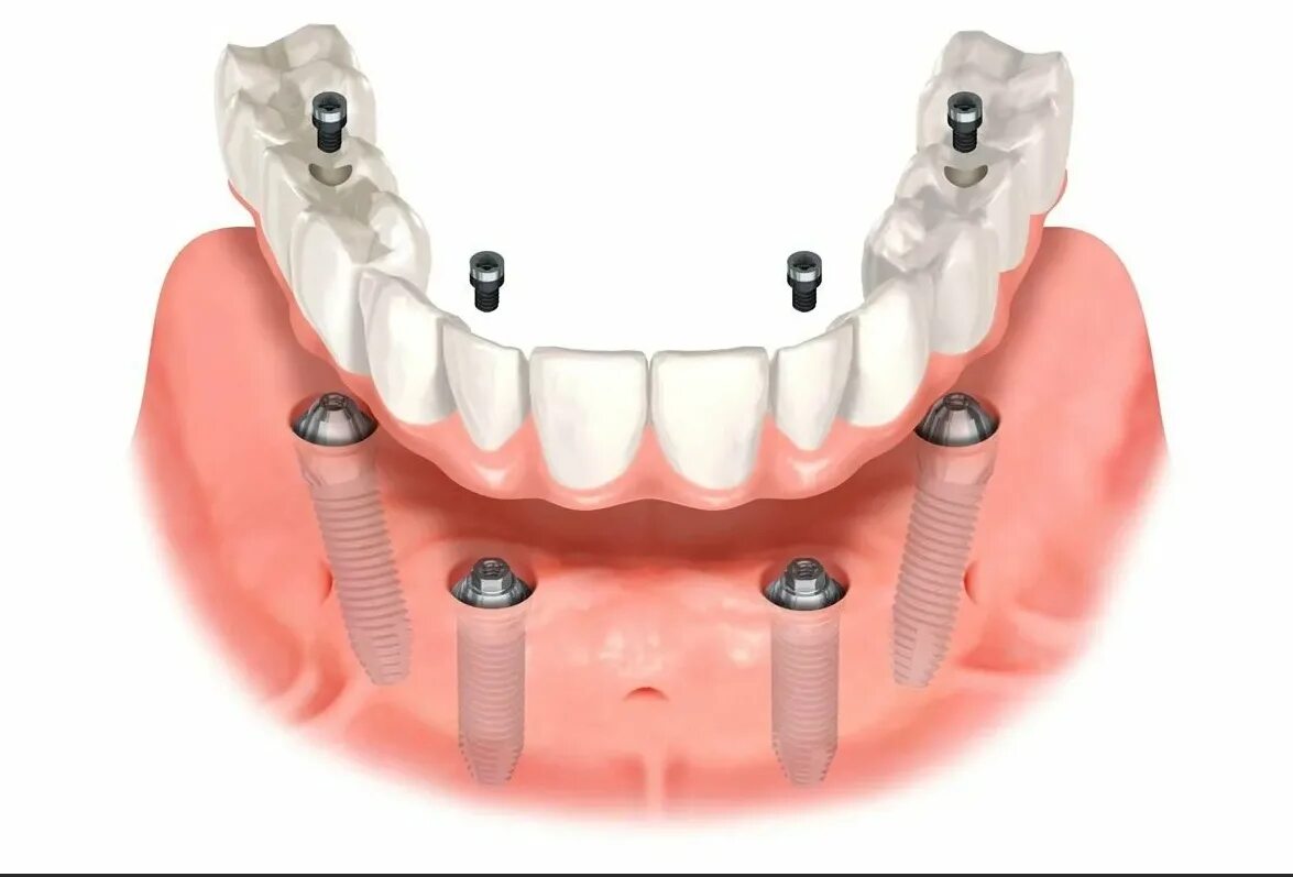 Имплантация зубов all on 6. Консольный мостовидный протез на имплантах. Пластиночный съемный протез на имплантах. Имплантация челюсти на 6 имплантах. Несъемный протез на 4 имплантах.