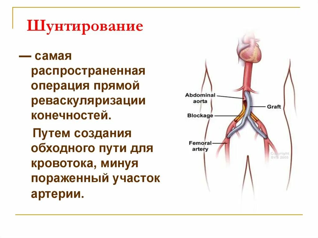 Шунтирование сосудов нижних конечностей. Шунтирование артериального сосуда. Операция шунтирования нижних конечностей