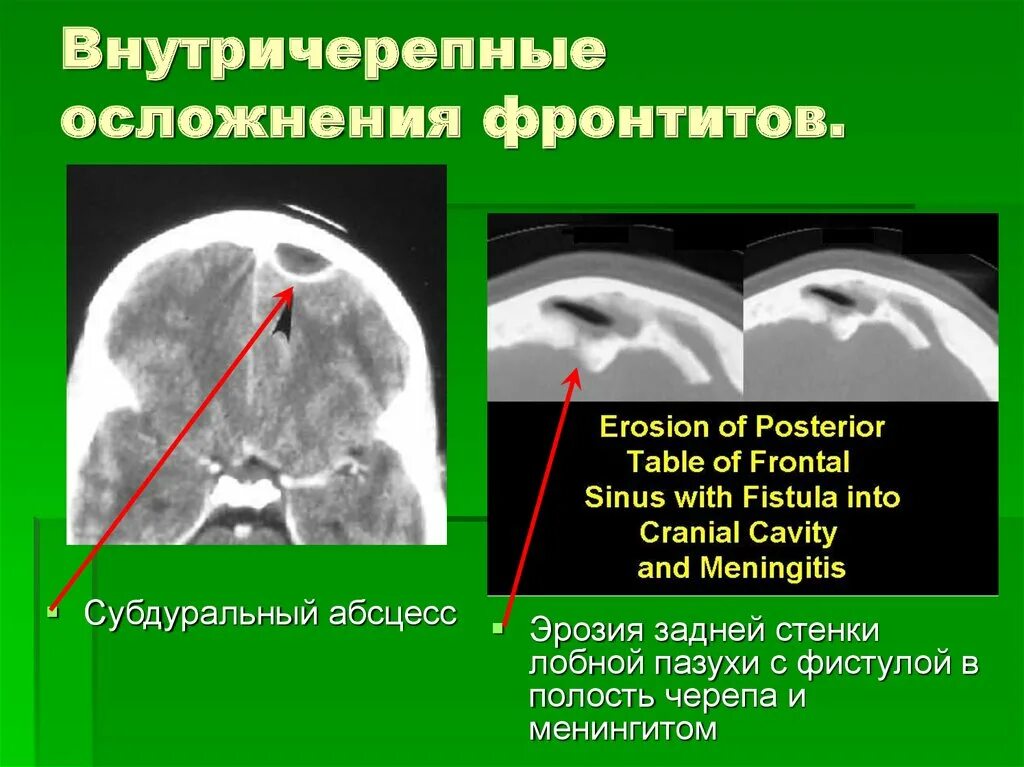 Может ли гайморит перейти в менингит